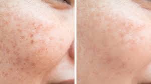 This face pack is the best one for all the ones with delicate skin. How To Get Rid Of Freckles Naturally Youtube