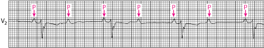 Care este tratamentul blocului atrioventricular de grad i? Bloc Auriculoventriculaire Troubles Cardiovasculaires Edition Professionnelle Du Manuel Msd