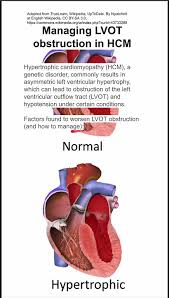 Image result for Left Ventricular Outflow Obstruction