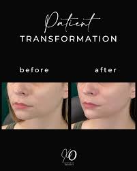 We loveeeee a natural transformation! A little bit of chin filler & jawline  filler can go a long way!!! Book your appointment with us today by calling  or texting 323-929-5875 ☎️ We