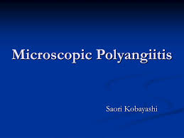 Image result for Microscopic Polyangiitis