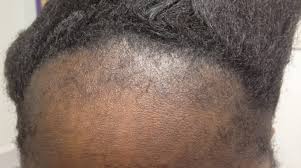 Androgenic alopecia is a genetic condition that can affect both men and women. Derm Dx Hair Loss In A Teen Girl Clinical Advisor