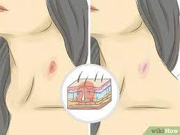 How To Give Someone A Hickey: 15 Steps (With Pictures) - Wikihow