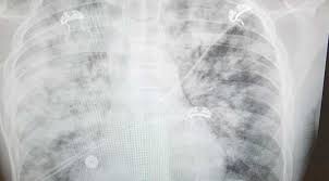 Image result for High Altitude Edema