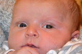 On rare occasions, it can occur on the outermost layer on the front of the eye (the conjunctiva), in the socket that surrounds the eye, or the eyelid itself.﻿﻿ Retinoblastoma Eye Cancer In Children Nhs