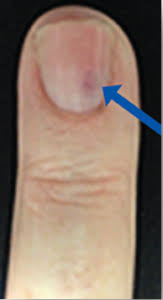 Image result for Glomus tumor