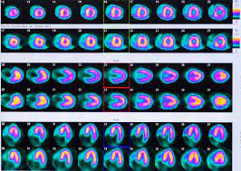 Visit & lookup immediate results now. Nuclear Cardiac Testing Clearwater Cardiovascular Consultants