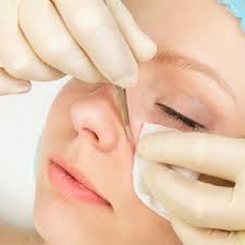 How to remove very deep blackheads. Graphic How Doctors Remove Blackheads Health24