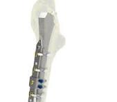 Ortholox® Locking Periprosthetic Support Cable-Plate Systems