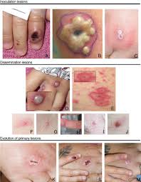 In 2017 nigeria experienced the largest documented outbreak, 40 years after the last confirmed case. Monkeypox Virus Infections Sciencedirect