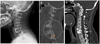 Joint mobilisation techniques can be used to unlock the facet joints, . Posterior Unlocking Of Facet Joints Under Endoscopy Followed By Anterior Decompression Reduction And Fixation Of Old Subaxial Cervical Facet Dislocations A Technical Note Sciencedirect