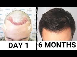It's no different to the other parts of this site where i publish the results of my research. 6 Month Results Hair Transplant Results Hair Transplant Hair Transplant Surgery
