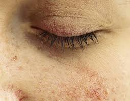 Dermatitis En Los Parpados Causas Y Tratamiento Oftalvist