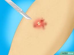 Maybe you would like to learn more about one of these? How To Treat A Staph Infection 14 Steps With Pictures Wikihow