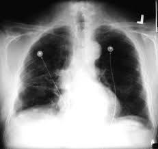 Pleural plaques are generally only indicative of asbestos exposure and have no prognostic. Asbestosis Workup Approach Considerations Radiography Ct Scanning