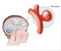 Kids Health Information : Cerebral Aneurysm