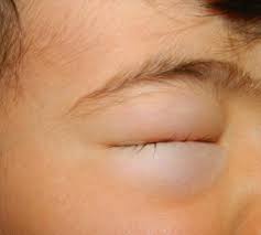 Toddler S Eye Swollen Shut