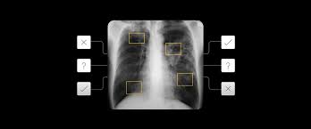 Tuberculosis generally affects the lungs, but can also affect other parts of the body. Tackling Tuberculosis Screening With Ai