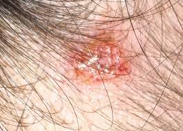 It can be very damaging to the skin it affects, but it very rarely metastasizes. I Have This Sore On My Neck On My Hair Line Is It Skin Cancer Ask A Doctor Free Best Answers Reviews Recommendations