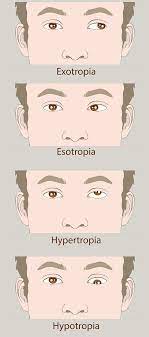 Lazy Eye Treatment In Rockville Centre | Rockville Centre Amblyopia  Treatment | Rockville Centre Lazy Eye