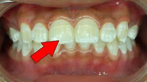 This happens because the bleaching agents affect the if you have a problem of white spots on your teeth, you should avoid foods that damage tooth enamel. 7 Ways To Get Rid Of White Spots On Teeth Youtube