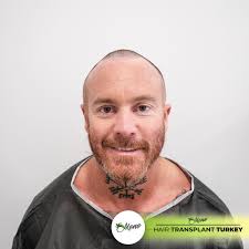 Mono Hair Transplant