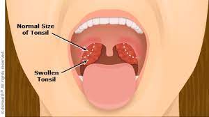 Tonsillectomy Information