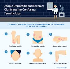 Check spelling or type a new query. Atopic Dermatitis And Eczema Clarifying The Confusing Terminology Nala Care Eczema App Digital Companion