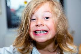 How to know if it is pain from a new tooth or cavity.? 4 Causes Of Chalky Teeth And What You Can Do About Them