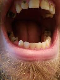 Baby Tooth Root Left Behind Find Out What Happens To The Roots Of Baby Teeth Kool Smiles