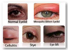Treatment Of Mosquito Bites On Eyelid Bites Treatment