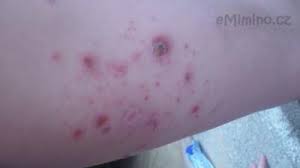 Image result for vyrážka u dětí