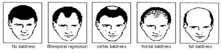 National library of medicine (nlm), more than 50 percent of all men over. Male Androgenetic Alopecia Endotext Ncbi Bookshelf
