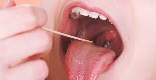 The white spots may not show up immediately but could take a few days, maybe even a few weeks before you see the white spots. Tonsillitis Symptoms Remedies Treatment Options Dr Axe