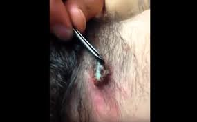 An ingrown hair occurs when a shaved or tweezed hair grows back into the skin. Ingrown Hair Infected Ingrown Hair Cyst In Pubic Area
