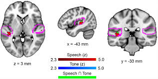 The primary auditory cortex is located in the _____ lobes. Cortical Correlates Of The Auditory Frequency Following And Onset Responses Eeg And Fmri Evidence Biorxiv