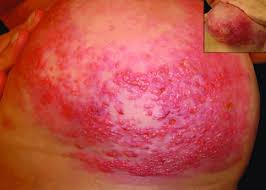 How fast does inflammatory breast cancer spread? Inflammatory Breast Cancer Clinical Presentation Download Scientific Diagram