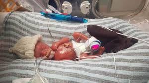 During the study, an experienced obstetrician was present during planned. Premature New Zealand Twins Born At 23 Weeks Otago Daily Times Online News