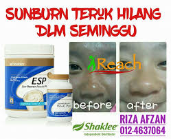 Kulit yang kerap terdedah kepada sinaran ultraviolet dari matahari bukan sahaja mengakibatkan sunburn, tetapi turut menimbulkan masalah lain seperti jeragat, pigmentasi dan kulit nampak lebih tua. My Health Venture 5 Cara Menghilangkan Sunburn Guna Bahan Semulajadi