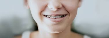 It is hard to reach the teeth in the back of your mouth. Braces How Braces Work Pain Relief Keeping Braces Clean
