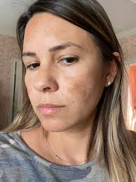 What product is best for combination skin with melasma?