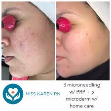 Microneedling PRP Vampire Facial Before & After