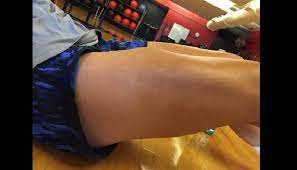 Ortho Dx Leg Pain After A Soccer Kick Clinical Advisor