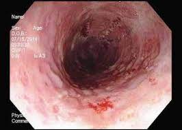 Infectious esophagitis (especially candida esophagitis) occasionally occurs in patients with diabetes mellitus or alcoholism, presumably because these diseases can impair immunity. Hsv Esophagitis