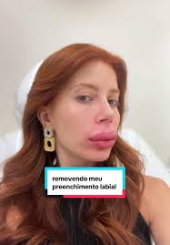 Reversão de intercorrências de preenchimento de olheira vindo de outro...