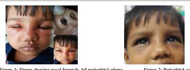 It easily spreads to the insides of both nostrils. Pdf A Rare Case Of Nasal Vestibulitis Complicating As Bilateral Preseptal Cellulitis Semantic Scholar