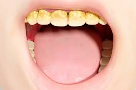 Image result for Tooth Discoloration