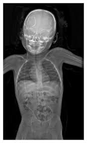 Example Of The Use Of Lodox In Vp Shunt Visualisation In Paediatric Download Scientific Diagram