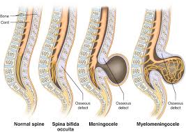 Image result for Dysraphism