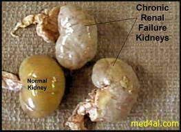 Capd, continuous ambulatory peritoneal dialysis; Chronic Renal Failure Causes Clinical Picture And Complications